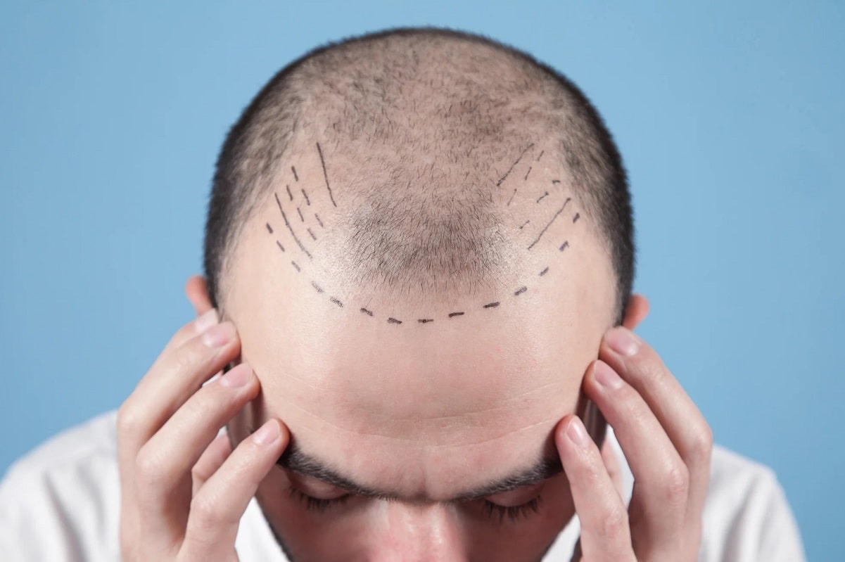 Which Country is Best for Hair Transplants?