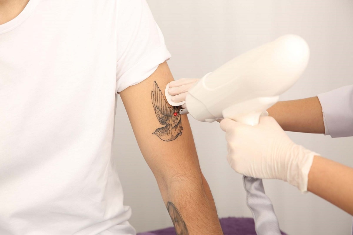 Boost Your Body Confidence by Removing Embarrassing Tattoos