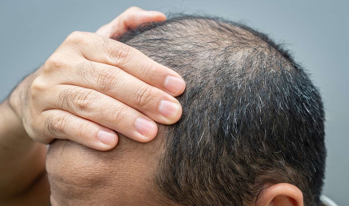 The Science of Hair Loss: Solutions for Men That Work